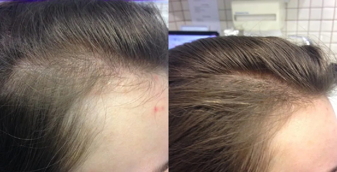 Мезотерапия для волос. Поредение волос у женщин. Мезотерапия волос картинки. Выпадают волосы коронавирус