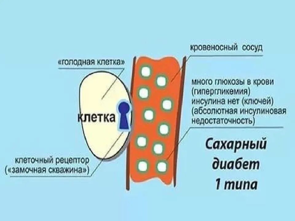 Диабет концентрат. Сахарный диабет 1 типа. Диабет первого типа. Механизм сахарного диабета. Диабет 1 типа механизм.