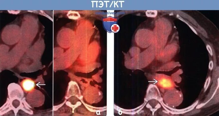 Кт после химиотерапии. Позитронно-эмиссионная томография опухоли. ПЭТ кт с контрастированием. ПЭТ кт семинома средостения.