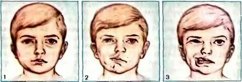 Лицевая болезнь
