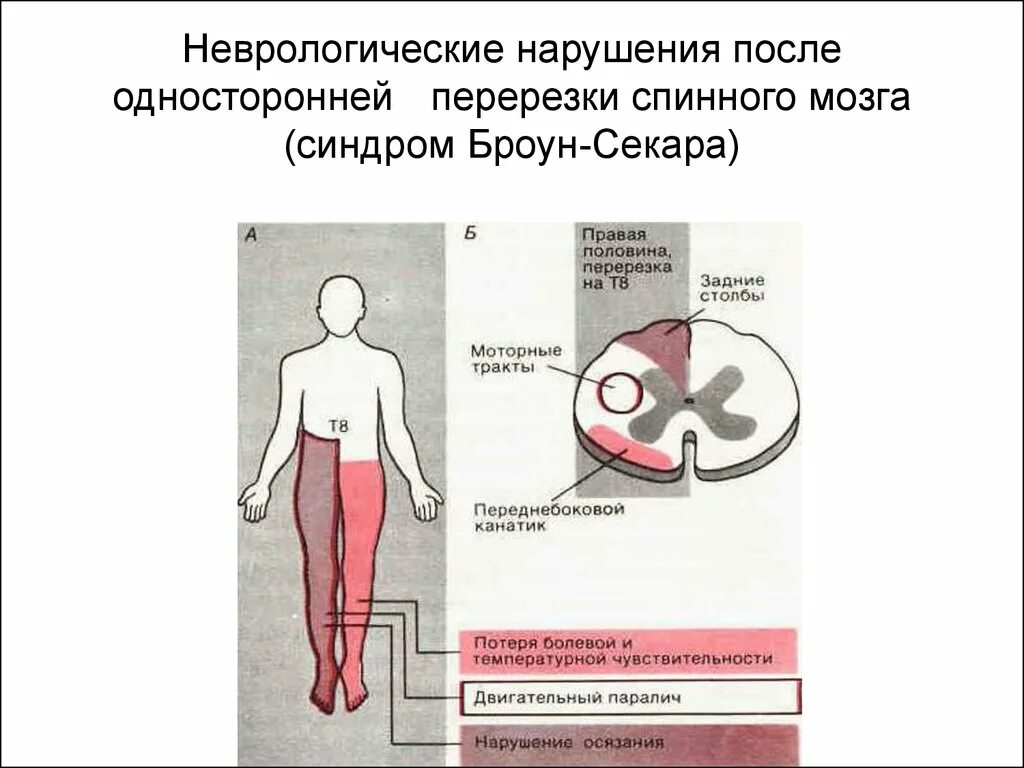 Основные причины развития синдрома Броун Секара. Синдром половинного поражения спинного мозга Броун Секара. Очаг поражения и симптомы при синдроме Броун-Секара. Синдром Броун Секара очаг поражения.