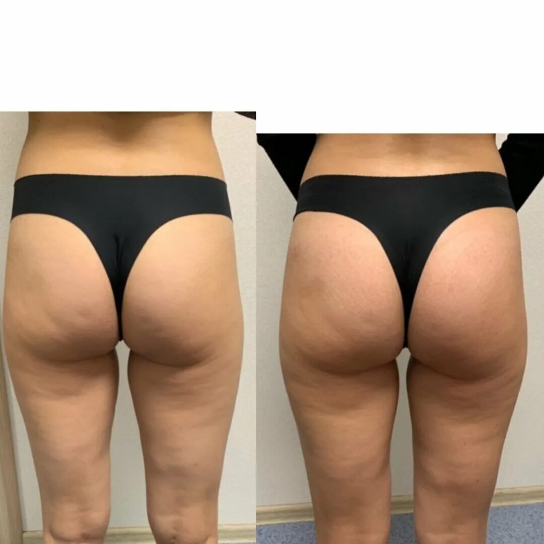 упражнения от складки под ягодицами. уменьшение ягодиц. вторая складка под ягодицей. как убрать под ягодицами. как убрать под ягодицами.