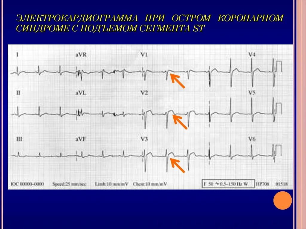 Экг подъем. ЭКГ при инфаркте миокарда с подъемом St. Инфаркт с подъемом сегмента St ЭКГ. ЭКГ при инфаркте с подъемом ст. Окс c подъемом сегмента St ЭКГ.