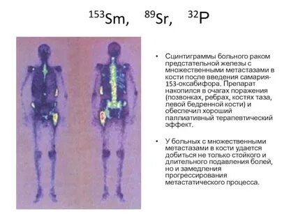 Метастазы в костях прогноз срока жизни