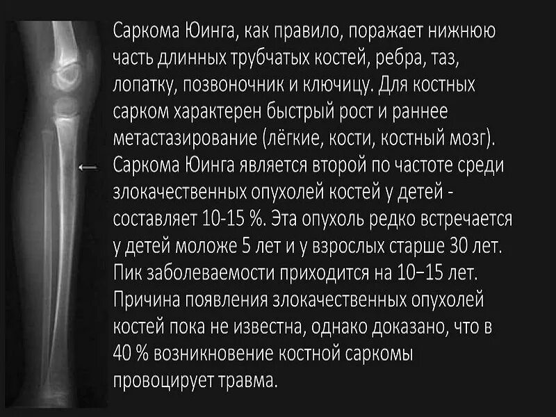 Диагноз саркома. Саркома Юинга малоберцовой кости. Саркома Юинга мягких тканей бедра. Саркома Юинга опухоль костей. Саркома Юинга крыла подвздошной кости.