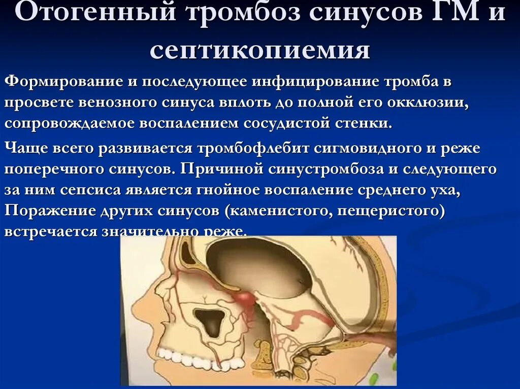 Тромбоз кавернозного синуса на кт. Тромбоз сигмовидного синуса симптомы. Тромбоз сигмовидного синуса клиника. Тромбоз пещеристого синуса. Церебрального тромбоза