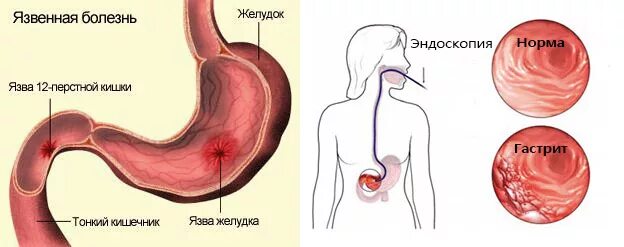 Почему заболел желудок