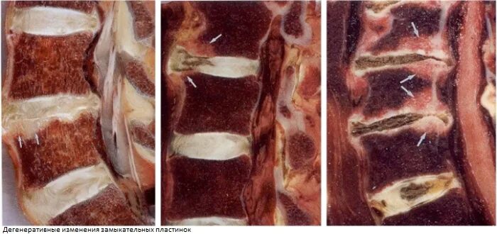 Склероз замыкательных пластинок позвоночника. Замыкательные пластинки тел позвонков. Дегенерация межпозвоночного диска. Дистрофия межпозвоночных дисков. Дегенерация дисков позвоночника.