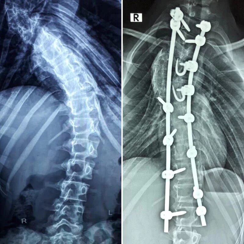 Операция на сколиоз 3 степени. Операция Котреля-Дюбуссе. Сколиоз 4 степени операция. Конструкция позвоночника операция
