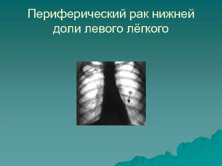 Периферическое образование левого легкого. Периферическое образование нижней доли левого легкого. Опухоль нижней доли левого легкого. Опухоль левого легкого верхней доли. Периферическое образование нижней доли правого легкого что это такое.