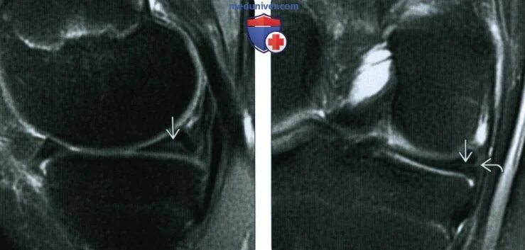 Повреждение мениска коленного сустава по stoller. Повреждение заднего рога медиального мениска Stoller 2. Мрт коленного сустава разрыв мениска.