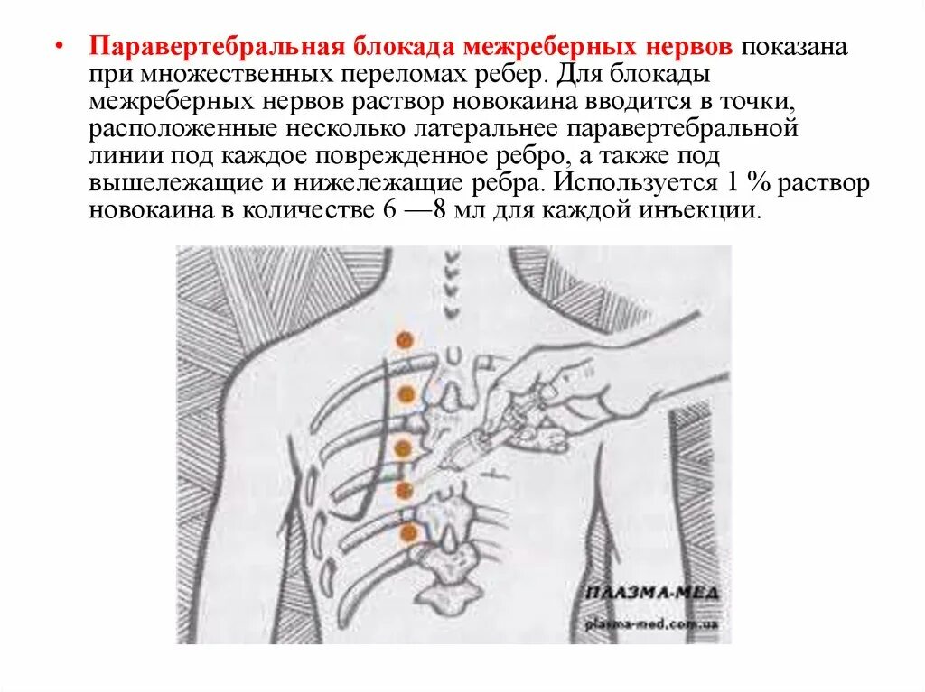 Межреберная блокада. Блокада межреберных нервов Оперативная хирургия. Блокада межреберных нервов топографическая анатомия. Шейная блокада проводниковая анестезия.