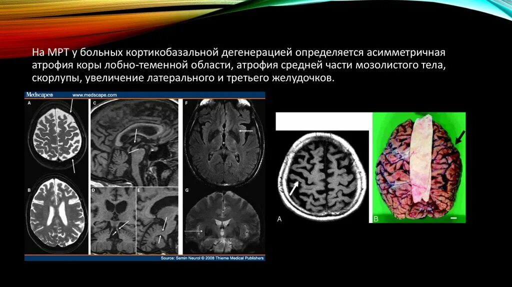 Кортикобазальная дегенерация. Валлерова дегенерация мрт. Кортикобазальная дегенерация мозг. Атрофия теменных областей.
