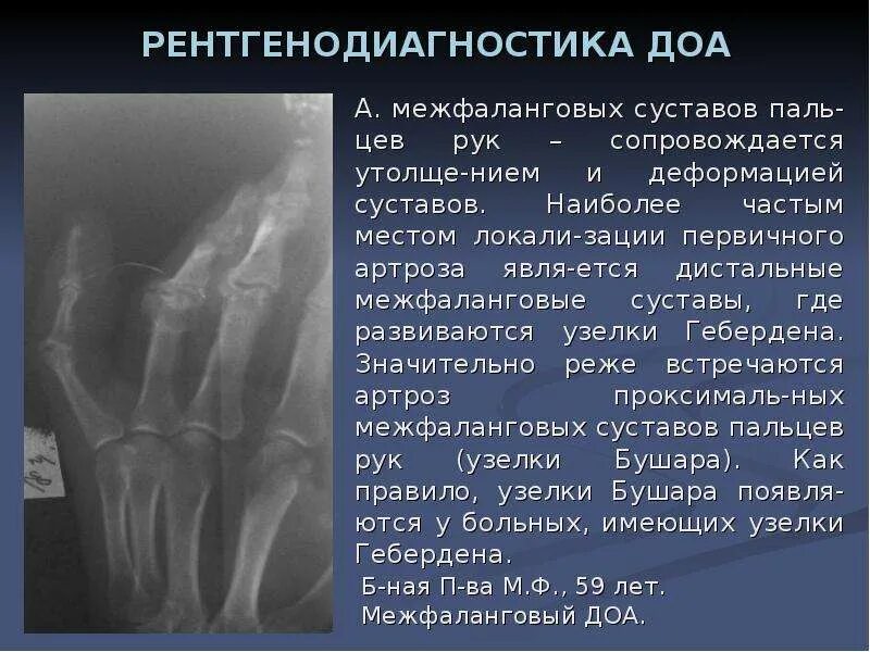 Артрит лучезапястного сустава рентген протокол. Узелки Гебердена регтгенописание. Доа лучезапястного сустава 3 степени рентген. Артроз межфалангового кистей рентген. Артрит межфаланговых