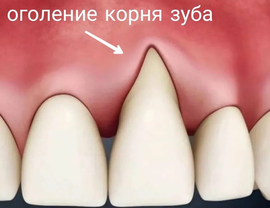 Исправляем форму десен