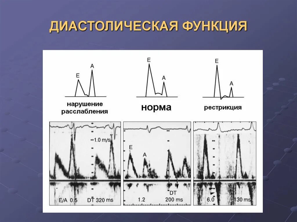 Нарушение функций 1 степени. Оценка диастолической функции левого желудочка. Нарушение диастолической функции типы. Оценка диастолической функции сердца. Нарушение диастолической функции по 1 типу.