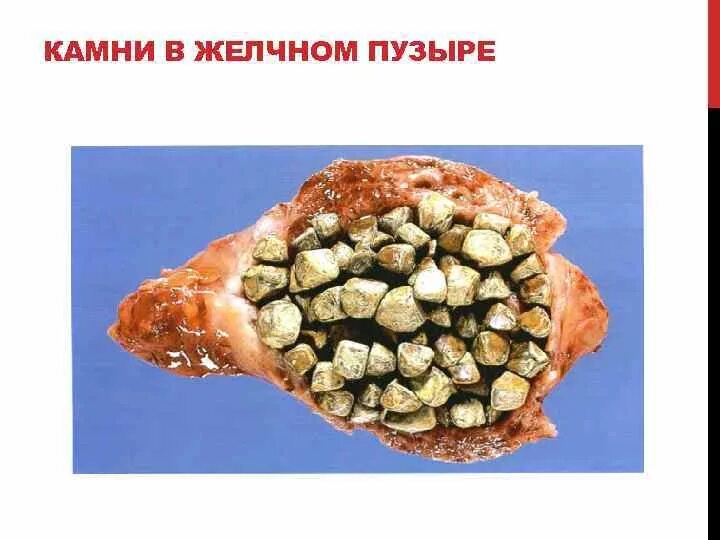 Какие симптомы при камнях в желчном. Калькулезный холецистит макропрепарат. флегмонозный холецистит. калькулезный холецистит камни в желчном. жкб острый калькулезный холецистит.