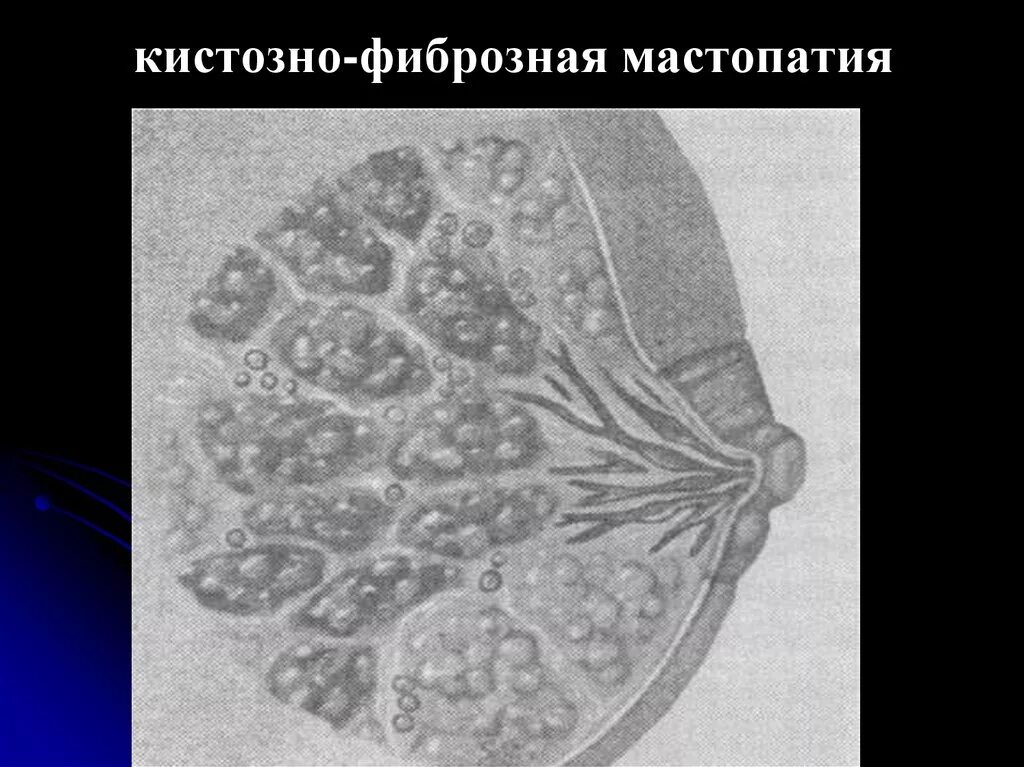 Диффузная мастопатия фиброзным компонентом. Фиброзная мастопатия гистология. Фиброзно-кистозная мастопатия молочной железы. Диффузионная фиброзно-кистозная мастопатия.