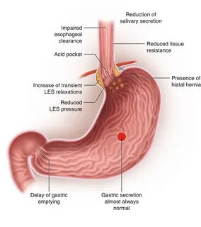 Acid Suppression For Management Of Gastroesophageal Reflux Disease. 