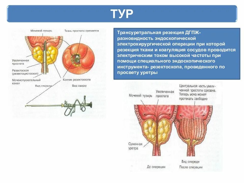 Трансуретральная резекция ДГПЖ. Трансуретральная резекция гиперплазии простаты. Операция при аденоме предстательной железы. Трансуретральная резекция аденомы предстательной железы.