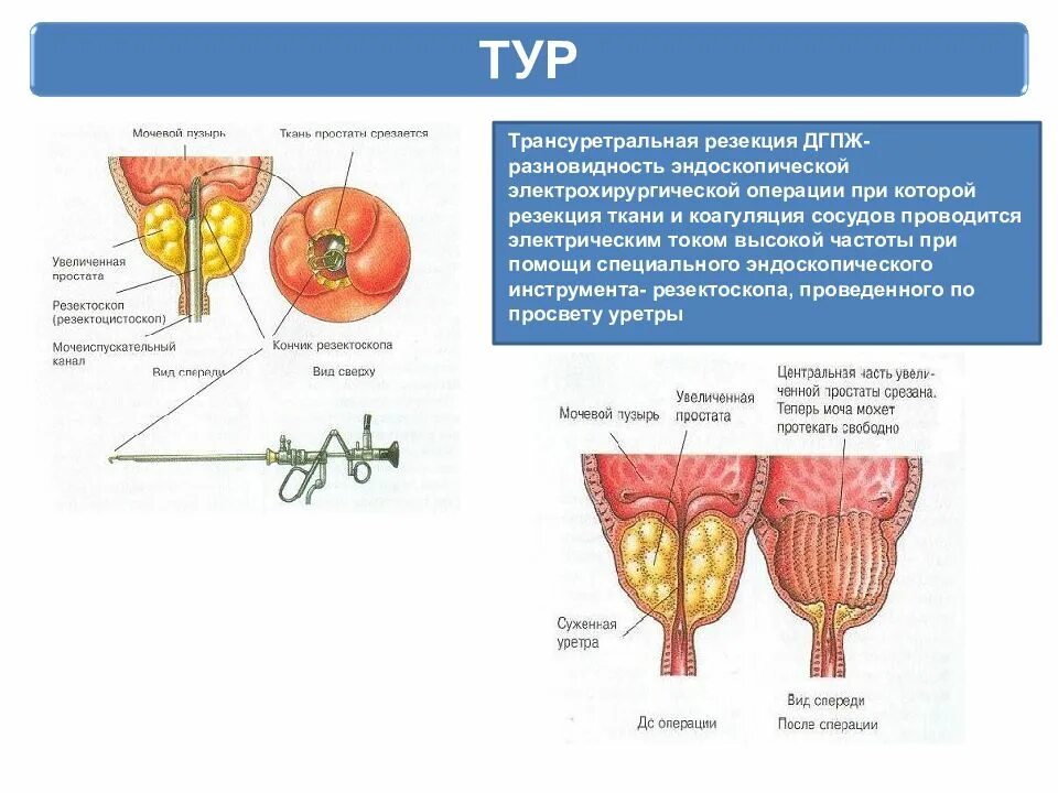 Трансуретральная резекция ДГПЖ. Трансуретральная резекция гиперплазии простаты. Операция при аденоме предстательной железы. Трансуретральная резекция аденомы предстательной железы. Гиперплазия предстательной железы операция