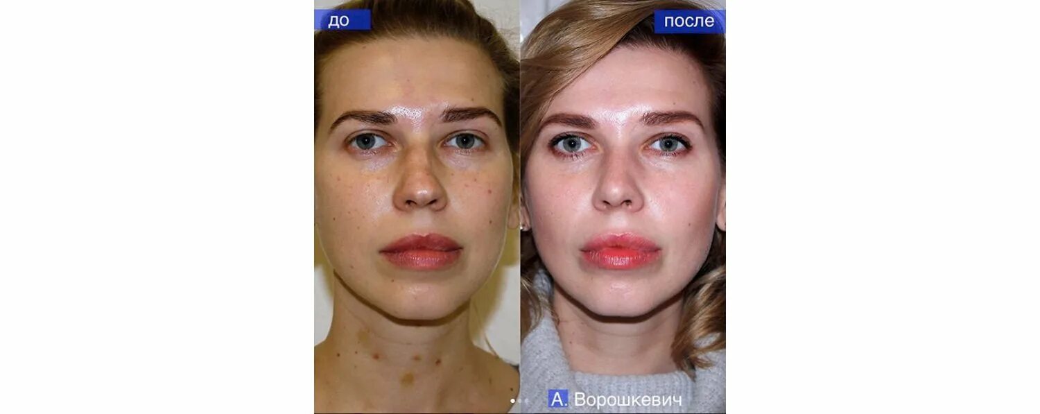 исправление асимметрии носа. исправление асстметрии носа. кривой нос одна сторона. кривой нос после пластики. кривой нос одна сторона.