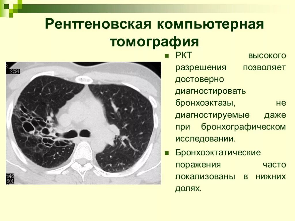 Ркт. Бронхоэктатическая болезнь легких на кт. Бронхоэктазы в легких на кт. Бронхоэктатическая болезнь кт. Цилиндрические бронхоэктазы на кт.
