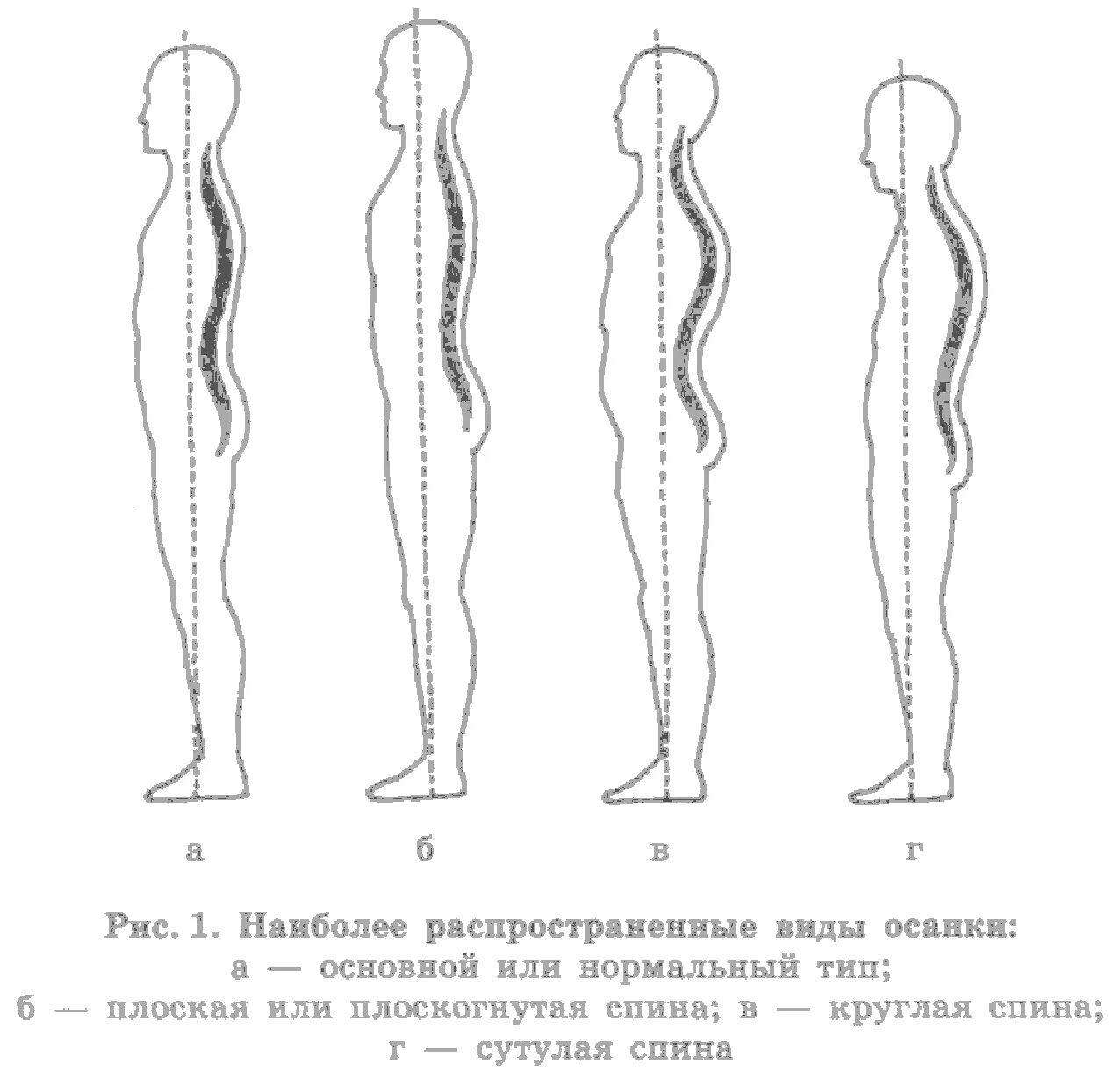 Виды искривления осанки человека. Типы нарушения осанки человека. Типы осанки по штаффелю. 4 Типа осанки человека. Изменение формы позвоночника