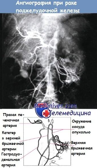 Химиотерапия при раке поджелудочной. Ангиография поджелудочной железы. кт ангиография поджелудочной железы. ангиография сосудов поджелудочной железы. ангиография при остром панкреатите.