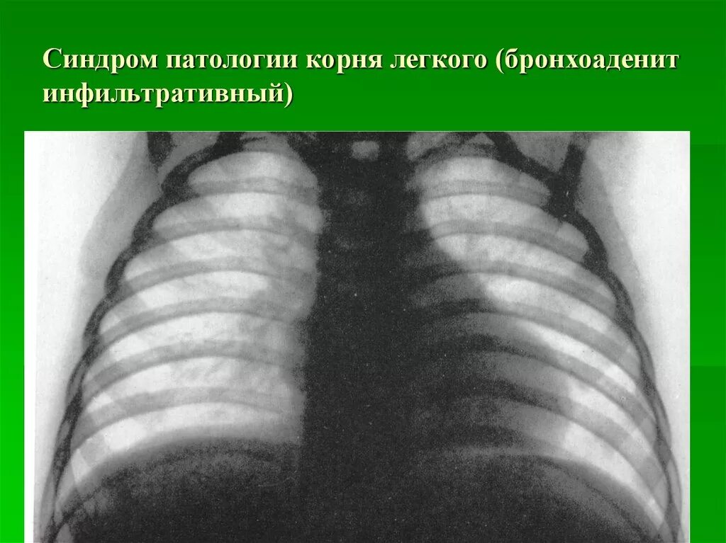 Инфильтративный бронхоаденит. Синдром патологии корня легкого. Неспецифический бронхоаденит. Синдром инфильтрации корня легкого. Изменения корня легкого