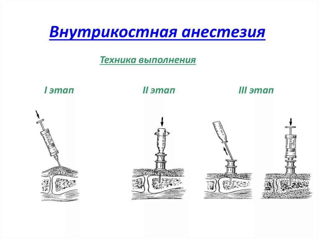 Внутрикостная блокада. Внутрикостная анестезия техника проведения стоматология. Внутрикостная регионарная анестезия. Методика внутрикостной анестезии. Внутрикостная анестезия техника.