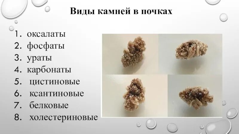 Мочевые камни бывают
