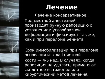 Перелом человека