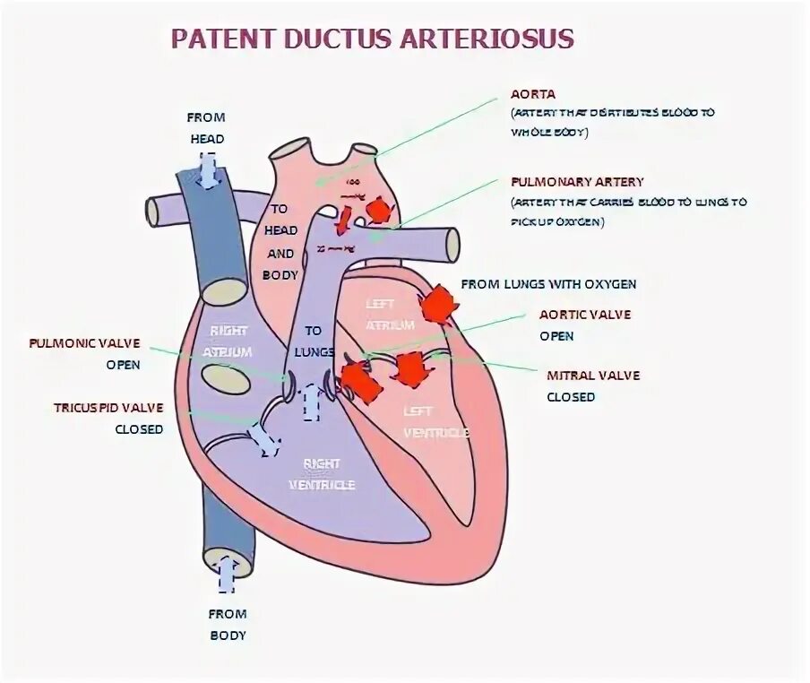Plexus arteriosus. Patent ductus arteriosus.