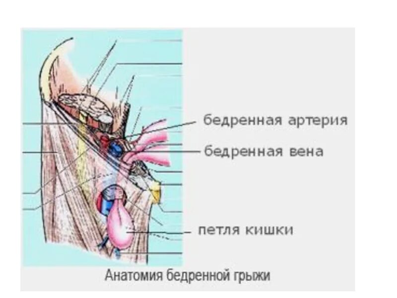 Ущемленная бедренная грыжа. Бедренная грыжа бедренная Вена. 2. Бедренная грыжа. Бедренные грыжи топографическая анатомия. Бедренная грыжа сосудистая лакуна.