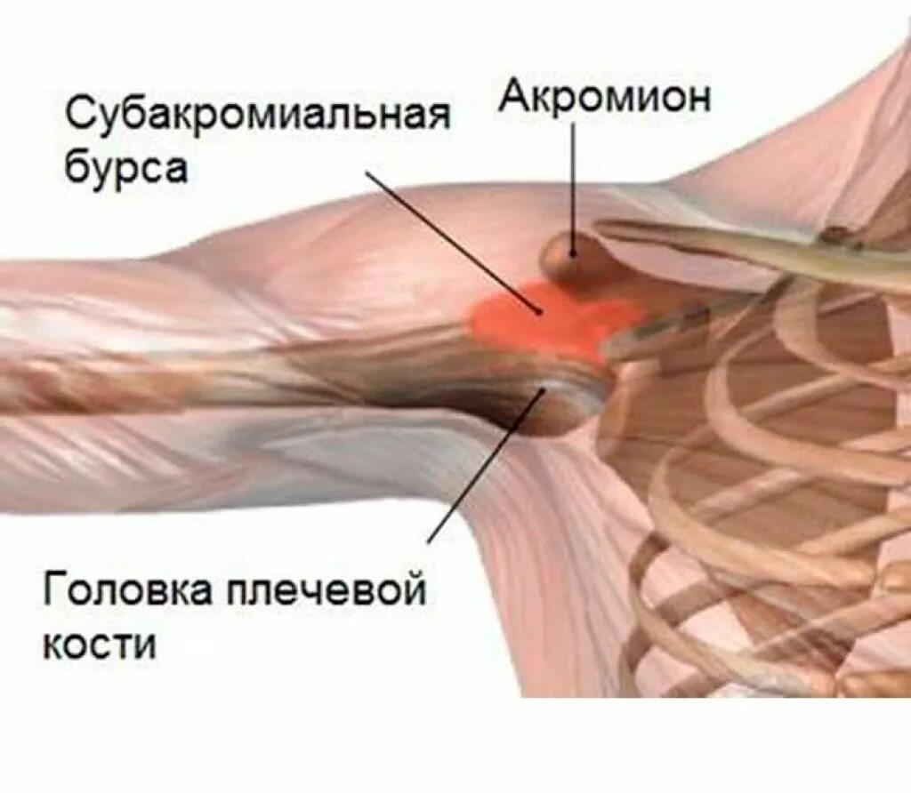 Эффективное лечение плечевого сустава. Субакромиальный бурсит. Субкоракоидальный бурсит плечевого. Субакромиальная сумка плечевого сустава. Субакромиальный и субкоракоидальный бурсит.