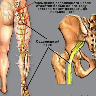 Тазовая невралгия у женщин