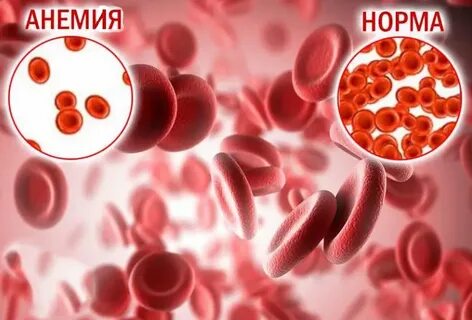 Анемия хронических состояний