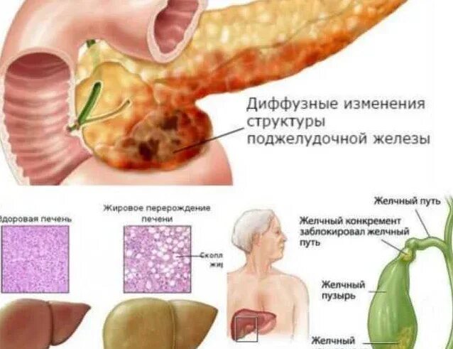 Выражена диффузные изменения поджелудочной железы. Реактивные изменения поджелудочной. реактивные изменения печени. диффузные реактивные изменения поджелудочной железы. реактивные диффузные изменения поджелудочной железы у ребенка.