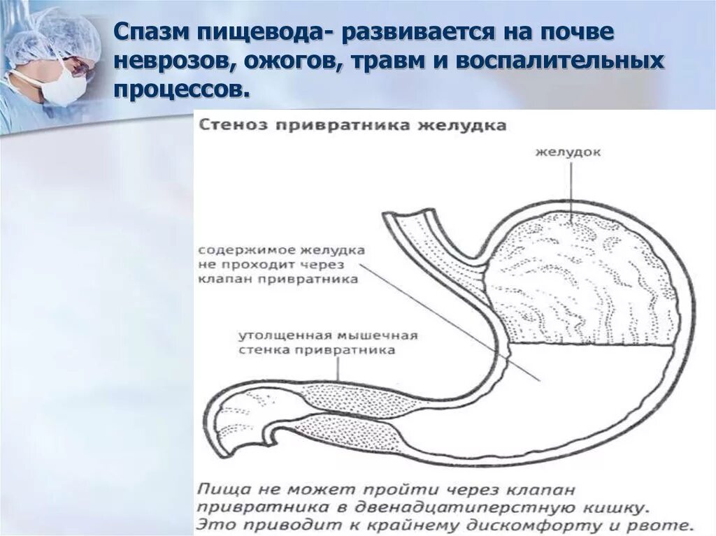 Диффузная пищевода. Спазм пищевода и желудка. Спастические сокращения пищевода. Спастические сокращения желудка.