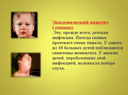 Паротит околоушной слюнной железы