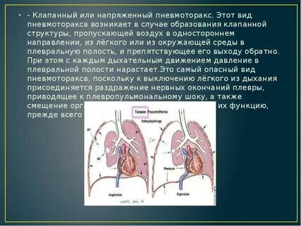 Пневмоторакс это скопление воздуха в