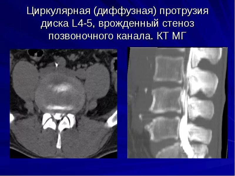 Задняя диффузная протрузия диска. Циркулярная протрузия диска l4-l5 кт. циркулярное выбухание диска l4/l5.. циркулярная протрузия межпозвонкового диска l4-l5. циркулярная протрузия диска на кт.