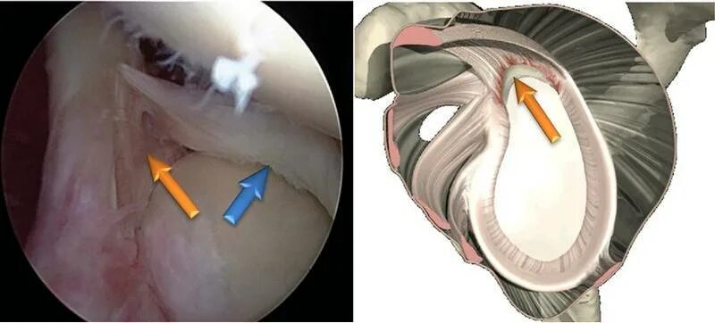 Плечевая губа суставная разрыв. Банкарта плечевого сустава. Банкарт повреждение плечевого сустава. Артроскопия плечевого сустава Банкарта. Синдром Банкарта операция.
