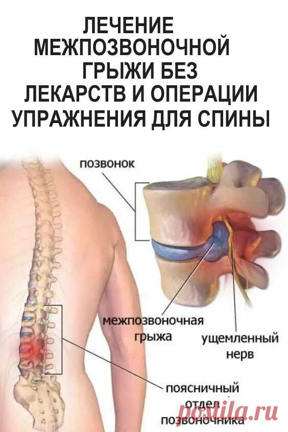 Грыжа лечится без операции. Межпозвоночная грыжа. излечение межпозвоночной грыжи.