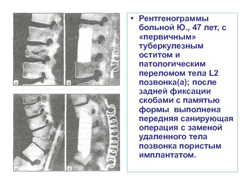 Лечение последствия компрессионного перелома позвоночника. Патологический перелом позвонка th8. Компрессионный перелом позвоночника th8. Патологический компрессионный перелом тела позвонка кт. Патологический перелом тела th12.