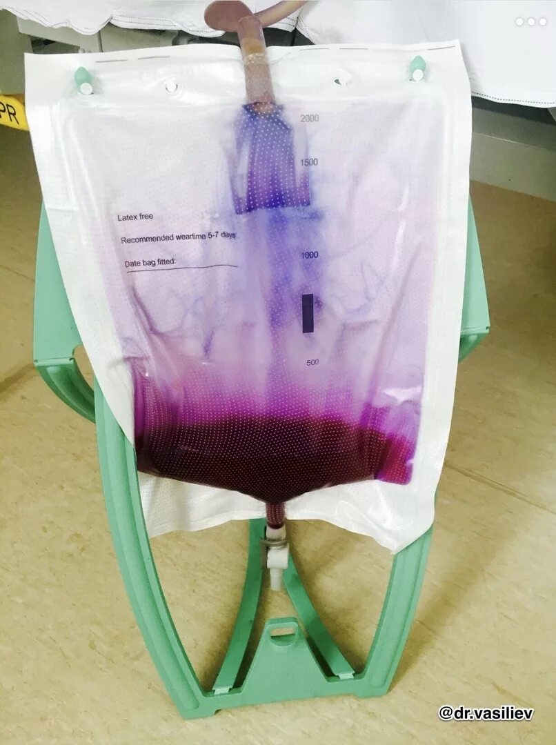 Фиолетовая моча. Kakashich. Фиолетовая моча. Моча с фиолетовым оттенком. Фиолетовая моча.