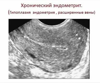 Эндометрия симптомы и причины