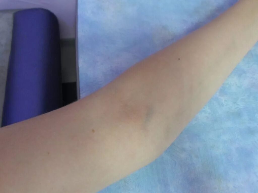 Болит вена в локте. Elbow pain. Elbow pain. Рука полностью. Узи артерий верхних конечностей протокол узи.