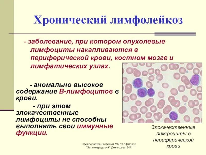 Кровь пои. Хронический лимфолейкоз бластные клетки. Хронические лимфицитик лейкоз. Лимфоцит хронический лейкоз. В -лимфоциты хронический лимфолейкоз.